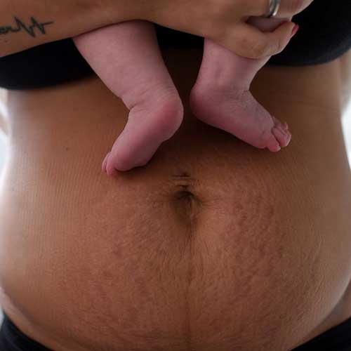 Postpartum Recovery